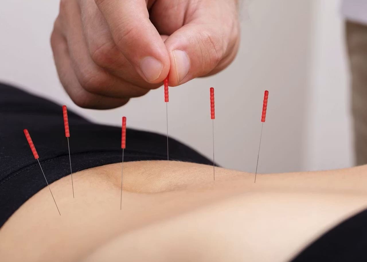 Dry Needling Physiotherapy