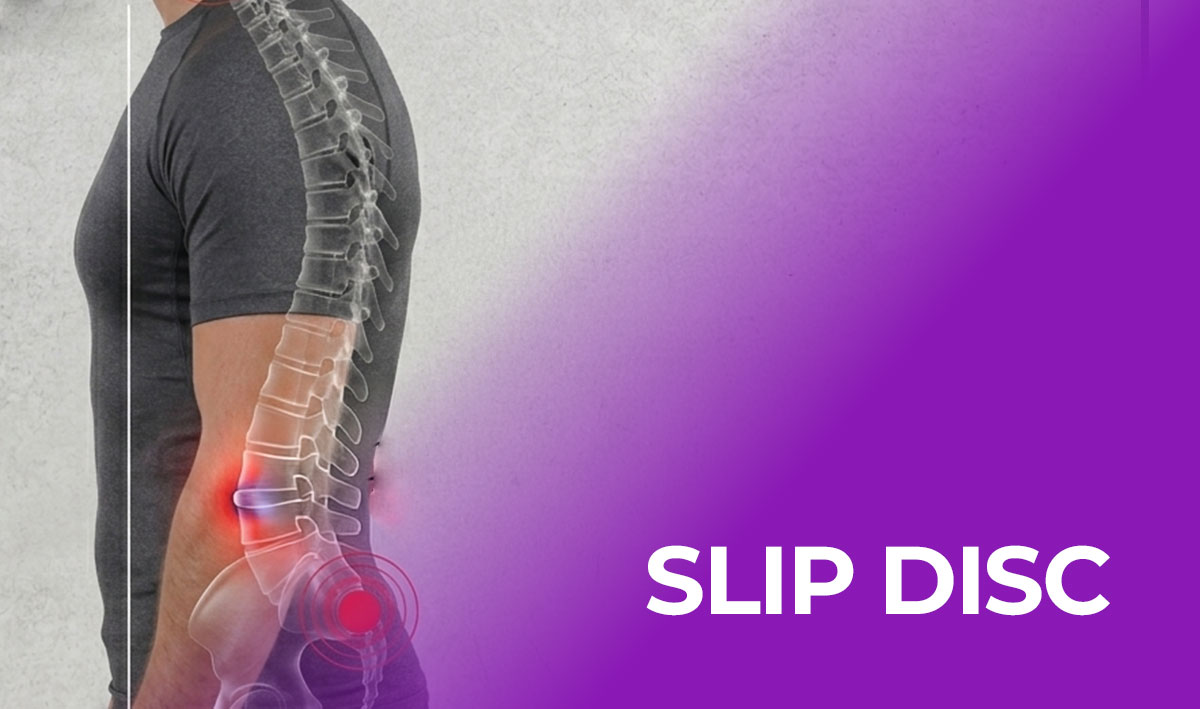 slip-disk